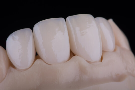 High-quality four dental crowns made of zirconium for fixation to the frontal teeth of upper jaw.