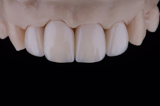 High-quality four dental crowns made of zirconium for fixation to the frontal teeth of upper jaw.
