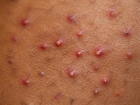 Active superficial folliculitis with inflamed hair follicles on brown skin
