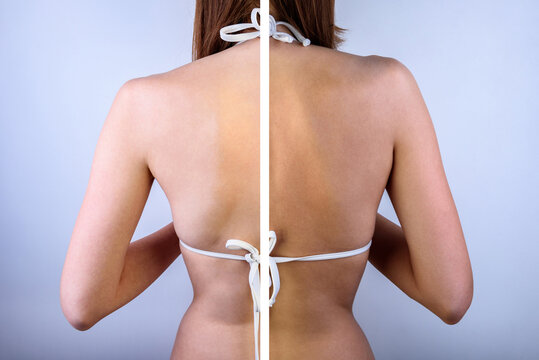 Young woman with slim body shape standing in white swimsuit before and after sunburn on gray background.