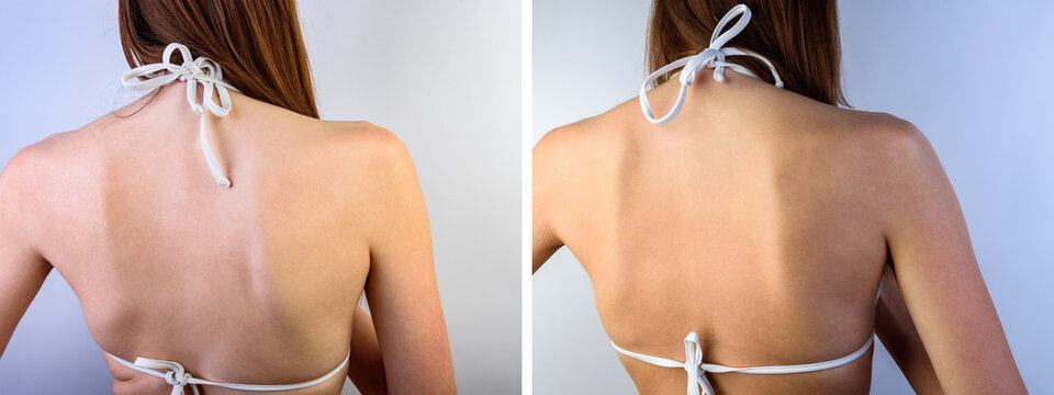 Young woman with slim body shape standing in white swimsuit before and after sunburn on gray background.