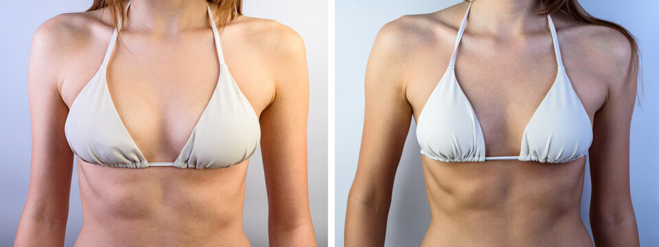 Young woman with slim body shape standing in white swimsuit before and after sunburn on gray background.
