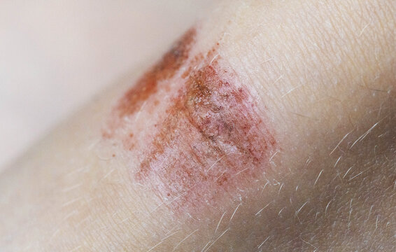 Close-up of acute injury on skin surface of human knee showing red scraped abrasion and minor bleeding, visual representation of injury and pain from fall