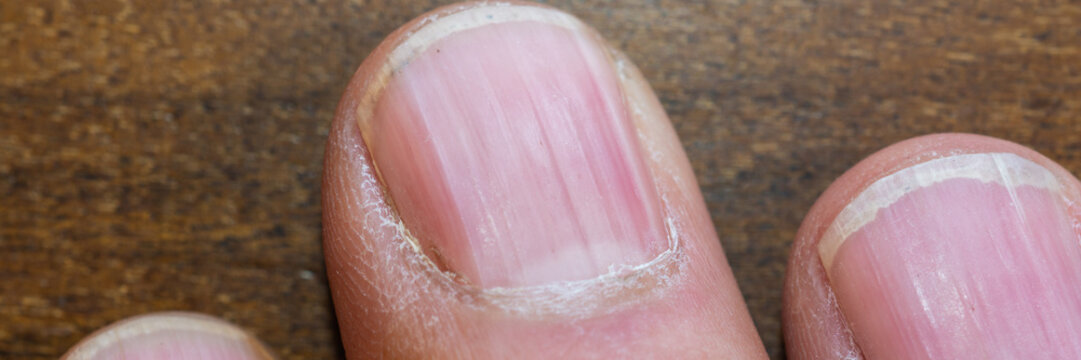 Extreme close-up of natural fingernails showing nail texture, cuticles and subtle surface ridges on a wooden background. Detailed dermatology, nail care, hygiene and health concept with copy space.