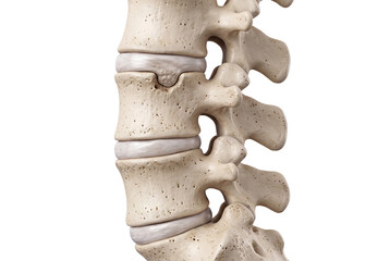 Obraz premium Medical illustration of lumbar vertebrae showing a Schmorl's node, where intervertebral disc material protrudes into the adjacent vertebral body.