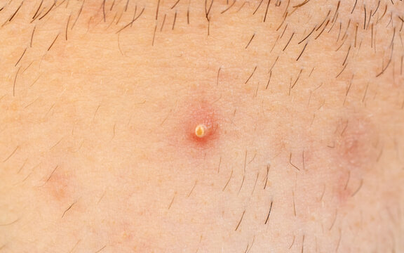Acne on face skin, macro texture, skincare and dermatology problem