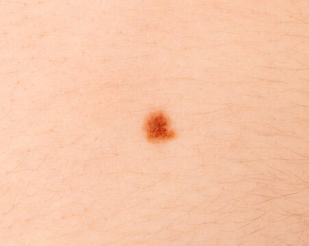 Skin mole closeup. Macro photo of blemish similar to melanoma