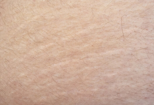 Scars from stretch marks, striae on skin texture closeup