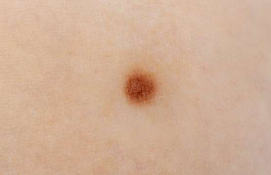 Skin mole closeup. Macro photo of blemish similar to melanoma