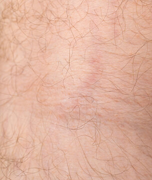 Scars from stretch marks, striae on skin texture closeup