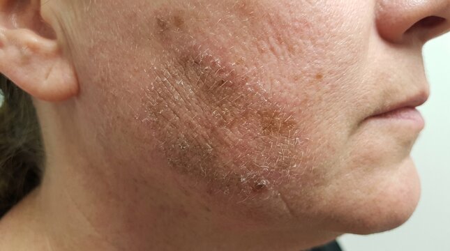 Facial Lichen Simplex Chronicus Realistic Clinical Dermatology Photograph with Lichenified Skin