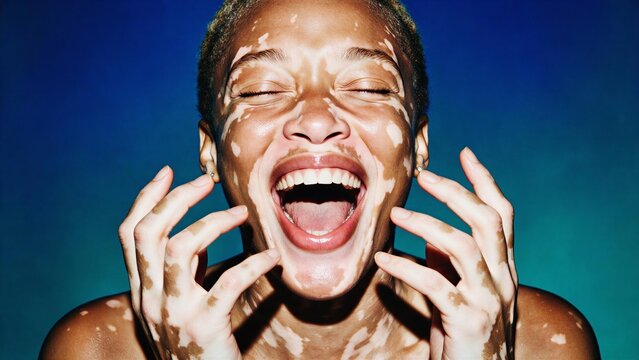 Powerful beauty portrait celebrating vitiligo skin, flash photography editorial &mdash; perfect for inclusive beauty campaigns, skin positivity brands, and diversity marketing
