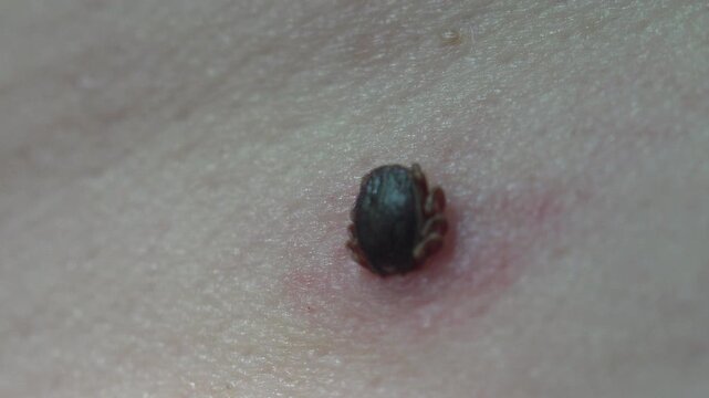 Hard tick attached to human skin, mouthparts under the surface and inflamed red skin around the bite. Medical macro, static shot, very shallow depth of field