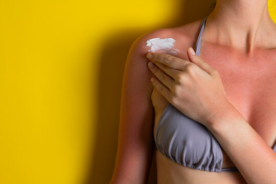 Close up of sunburned skin with severe redness and sunscreen cream applied to shoulder, UV damage concept