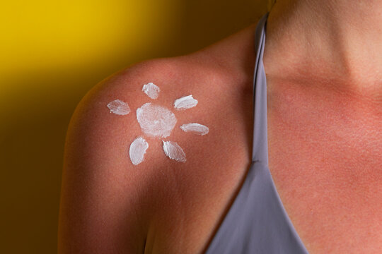 Close up of sunburned skin with severe redness and sunscreen cream applied to shoulder, UV damage concept