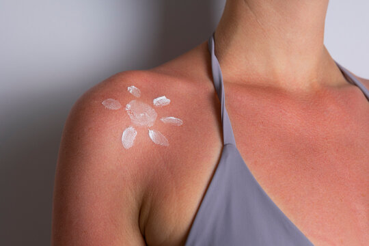 Close up of sunburned skin with severe redness and sunscreen cream applied to shoulder, UV damage concept