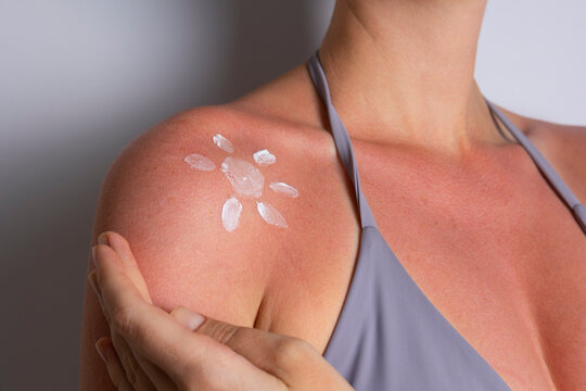Close up of sunburned skin with severe redness and sunscreen cream applied to shoulder, UV damage concept