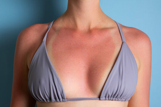 Close up of sunburned skin with severe redness and sunscreen cream applied to shoulder, UV damage concept