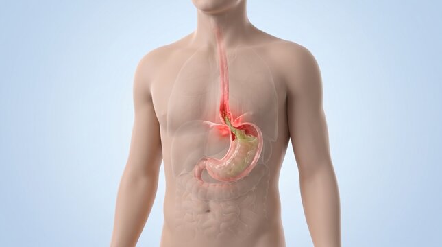 gastroesophageal reflux disease GERD shown inside semi-transparent torso with irritated lower esophagus and gastroesophageal junction in premium clinical CGI.