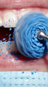 Close-Up of Teeth Cleaning Procedure with Polishing Tool and Blue Paste, Demonstrating Oral Hygiene Techniques for a Brighter Smile