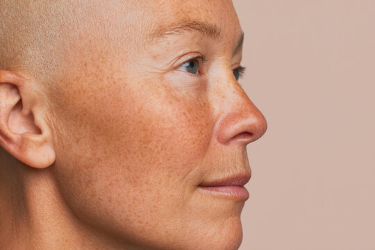 Bald breast cancer survivor woman in close-up profile