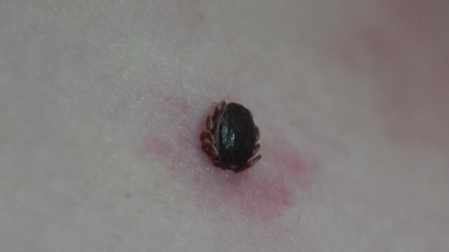 Hard tick attached to human skin with red irritation around the bite site, extreme macro illustrating tick-borne disease risk, prevention and first aid