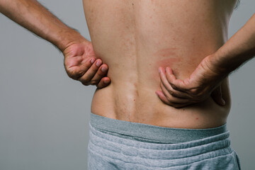 Naklejka premium A man with a summer tan massages his sore lower back with his fingers. A guy in gray shorts, turning away from the camera, scratches his pimply back. men's health: prevention of spinal diseases