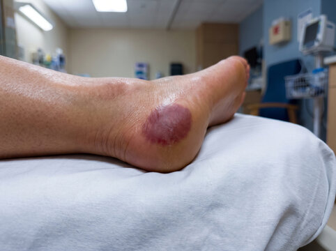 Early Stage Pressure Injury Non Blanching Redness on Adult Heel, Bedsore Prevention Nursing Care Medical Photograph