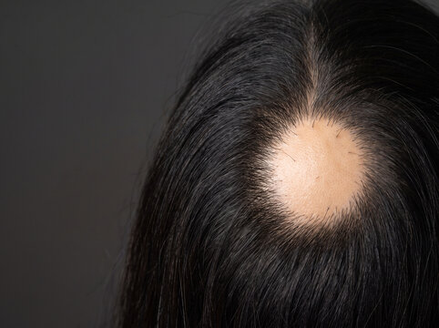 Alopecia Areata Smooth Round Bald Patch with Exclamation Mark Hairs on Adult Scalp, Autoimmune Hair Loss Medical Image