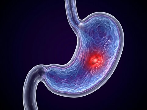 Human stomach with a visible ulcer and inflammation highlighted in red.