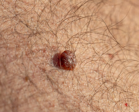 Skin lesion with dark, raised center surrounded by fine hairs