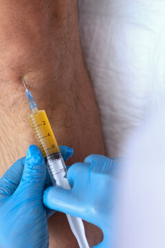 Intraarticular injection of platelet-rich plasma into patient's knee for joint treatment in an orthopedic clinic. Plasma therapy procedure in orthopedic clinic. Top view. Patient's own biomaterial