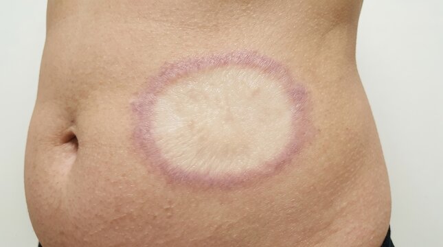 Close-up of localized scleroderma and morphea plaque on female abdominal skin