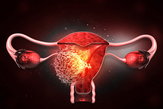 Cancer cells growth inside human female uterus organ structure on a dark medical laboratory background. 3d illustration