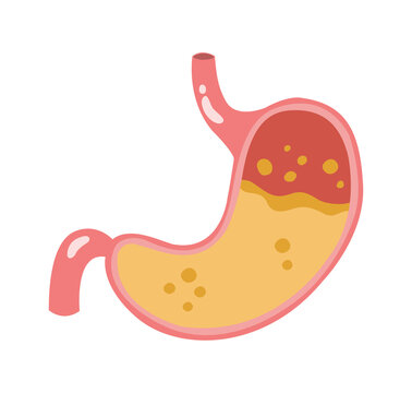 Illustrated human stomach cross-section showing gastric acid and digestive contents