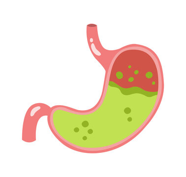 Stomach illustration with green acid and red inflammation showing digestive discomfort
