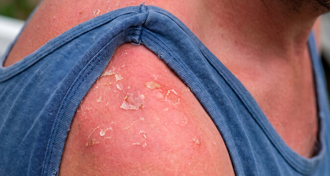 Close up of a peeling sunburned shoulder showing damaged red skin after excessive sun exposure