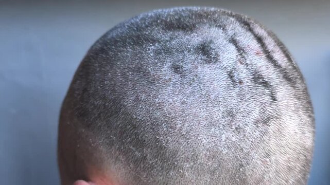 male scalp affected by seborrheic dermatitis, with visible dry skin patches and redness. skin condition is common and can cause itching and irritation, seborrhea requiring proper care and attention.