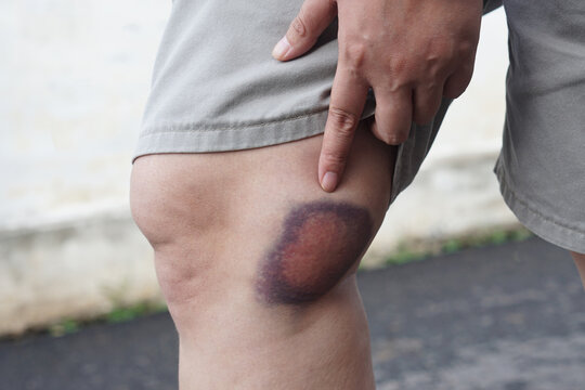 Close-up of a person showing a large bruise on the knee after an injury, with a finger pointing at the affected area, illustrating pain, accident, trauma, and first aid.