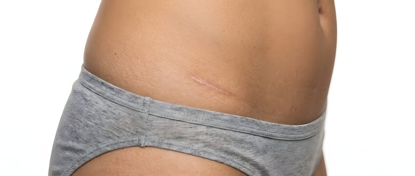 Human abdomen skin texture with stretch mark detail close up view