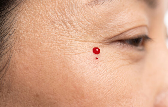 Macro Close Up of Bleeding Cherry Angioma Red Blood Drop on Senior Woman Face