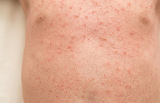 Widespread Red Viral Exanthem Rash Measles or Chickenpox on Child Torso