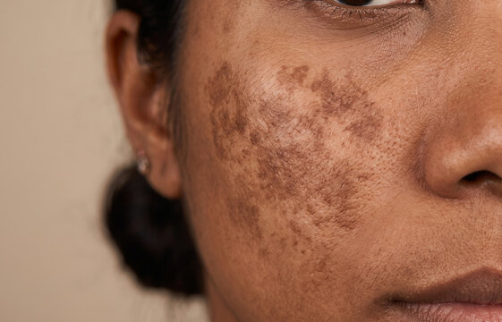 Close Up of Severe Melasma and Hyperpigmentation on Dark Skin Woman Cheek
