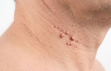 Fototapeta premium Macro Detail of Multiple Skin Tags Acrochordons on Human Neck