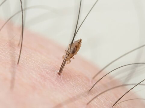 Macro photo of a head louse clinging to a hair strand on a human scalp. Parasitic insect close up. Pediculosis infestation concept