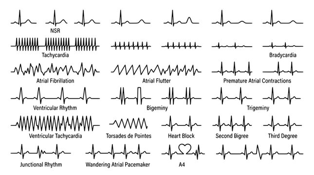 Set of human heart rhythm ECG patterns including normal sinus rhythm, tachycardia, atrial fibrillation and various cardiac arrhythmias.