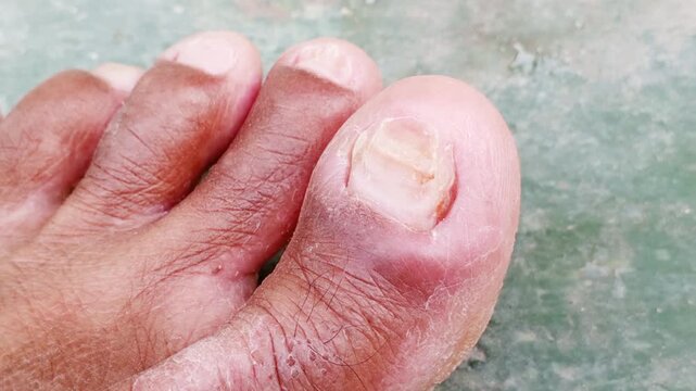 Toenails that are thickened, yellowish, brittle, and have an uneven surface may be caused by a fungal nail infection (onychomycosis), nail psoriasis, or chronic trauma or injury.