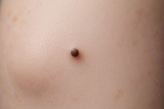 Macro shot of a brown mole on smooth light skin. Shows skin texture with pores and slight discoloration. Medical close up detail of birthmark on human body.