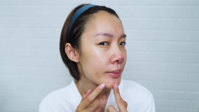Close-up portrait of a worried Asian woman touching a red pimple on her chin, looking at camera. Facial acne problem, skin trouble, blemish concern, and dermatology concept.