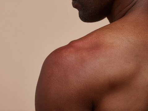 Close up of a person s shoulder and upper arm with clearly visible mild sunburn, realistic reddish skin and subtle uneven coloration, bright neutral